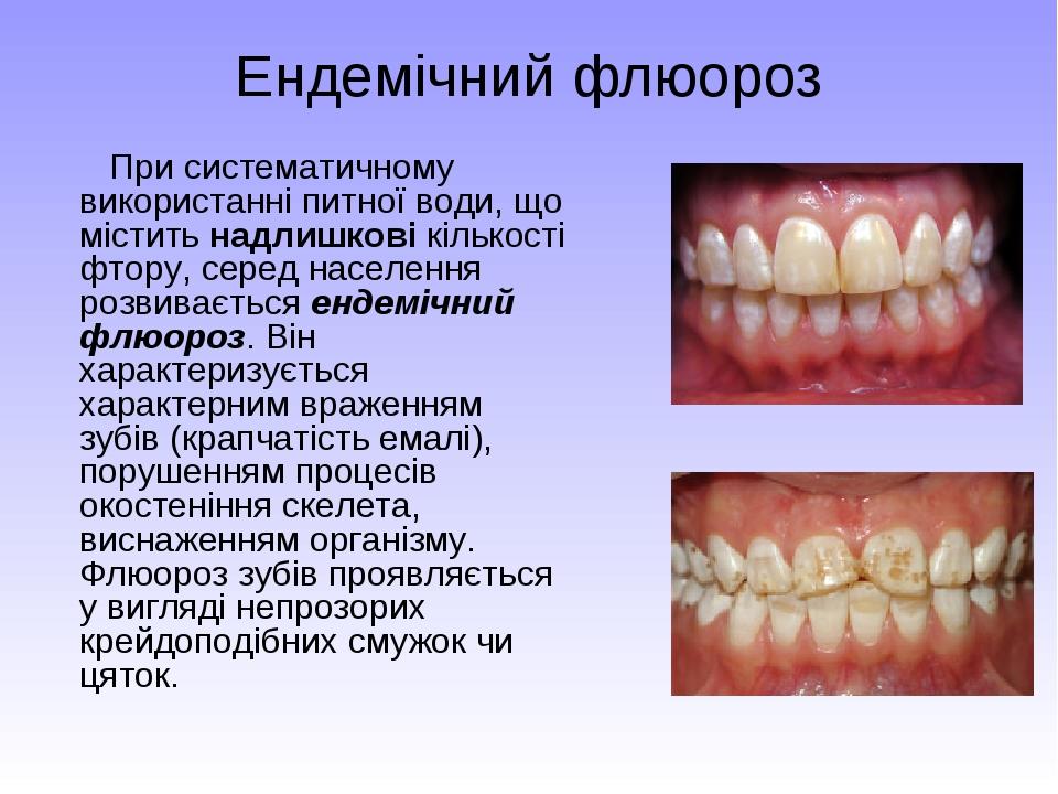 Муаровый рисунок эмали при флюорозе обусловлен