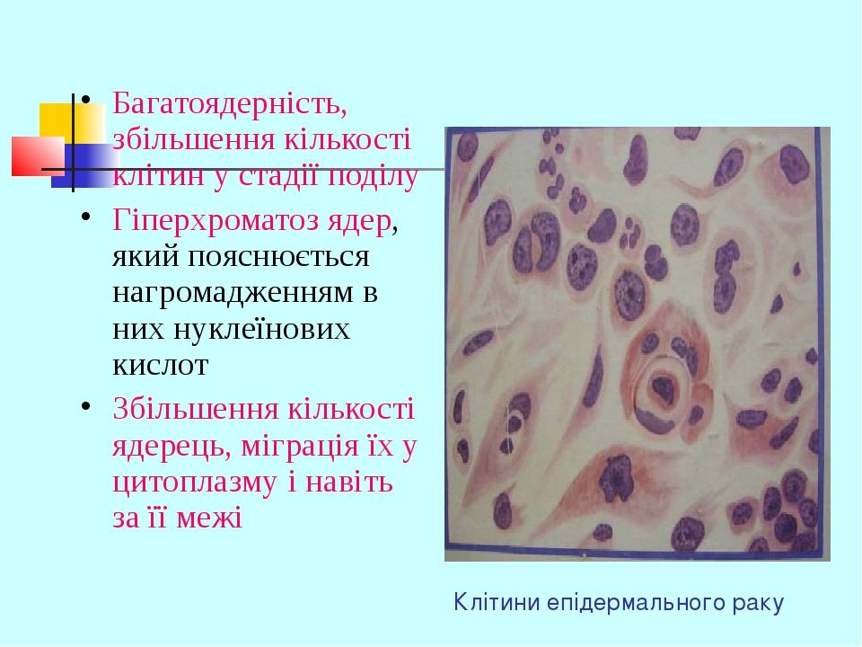 Клітини епідермального раку Багатоядерність, збільшення кількості клітин у стадії поділу Гіперхроматоз ядер, який пояснюється нагромадженням в них ...