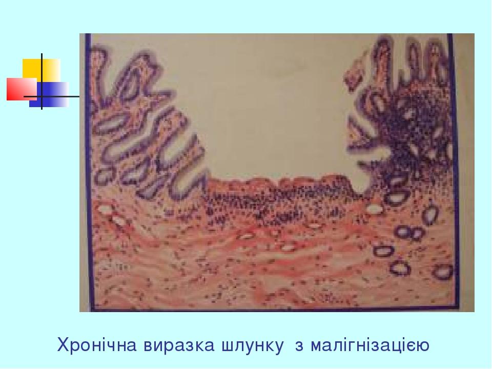 Хронічна виразка шлунку з малігнізацією