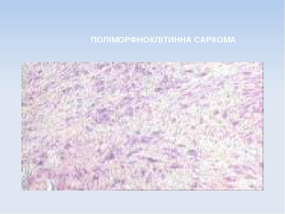 ПОЛІМОРФНОКЛІТИННА САРКОМА