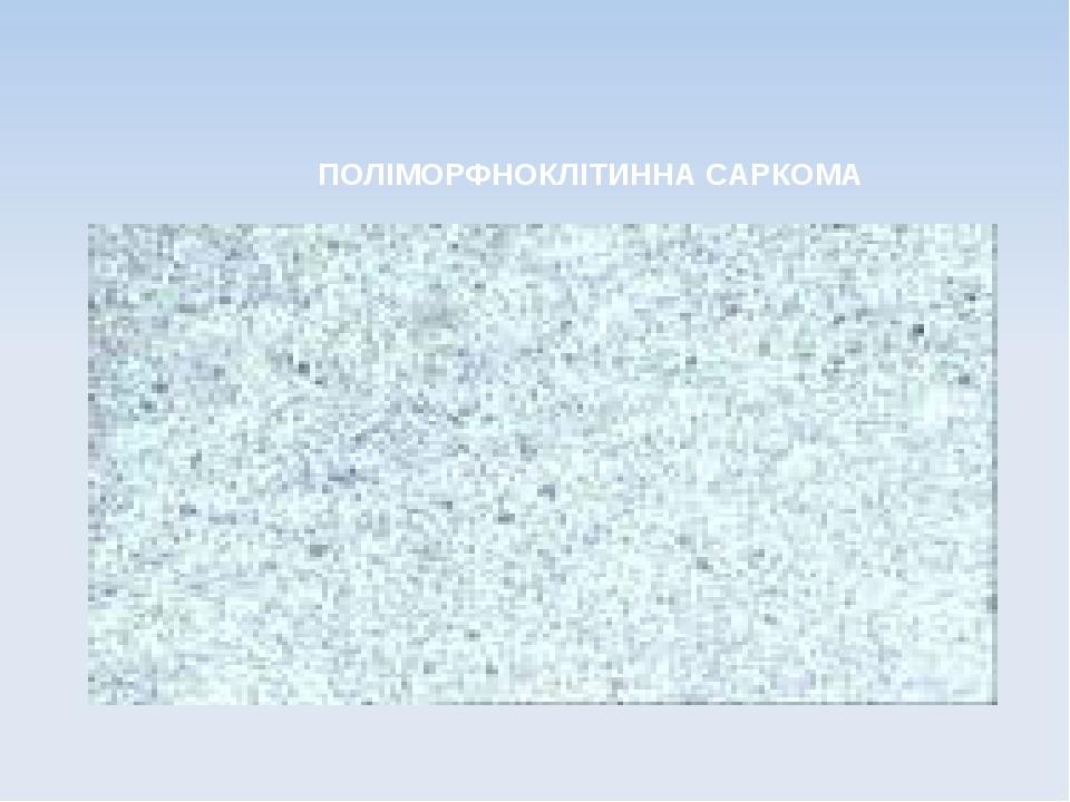 ПОЛІМОРФНОКЛІТИННА САРКОМА