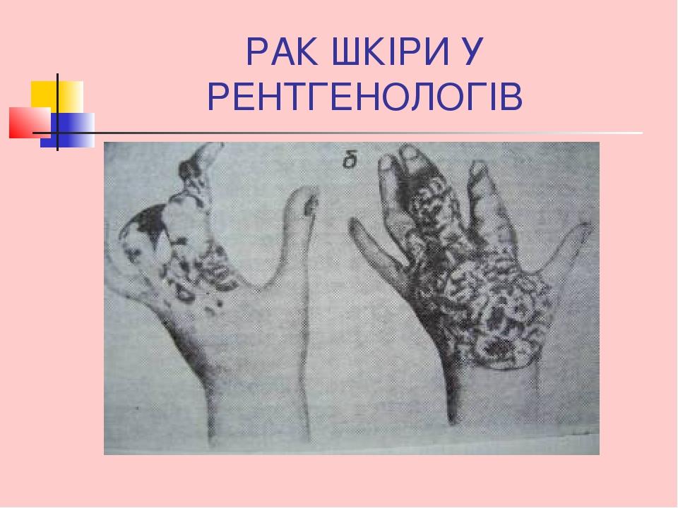 РАК ШКІРИ У РЕНТГЕНОЛОГІВ
