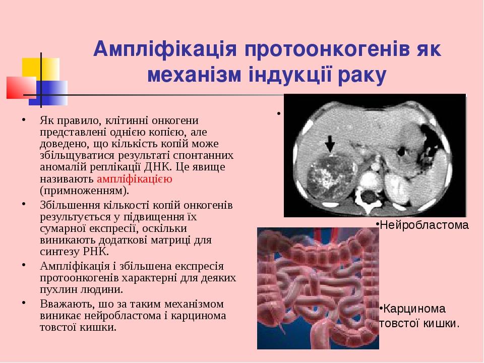 Ампліфікація протоонкогенів як механізм індукції раку Як правило, клітинні онкогени представлені однією копією, але доведено, що кількість копій мо...