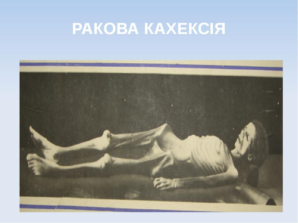 РАКОВА КАХЕКСІЯ