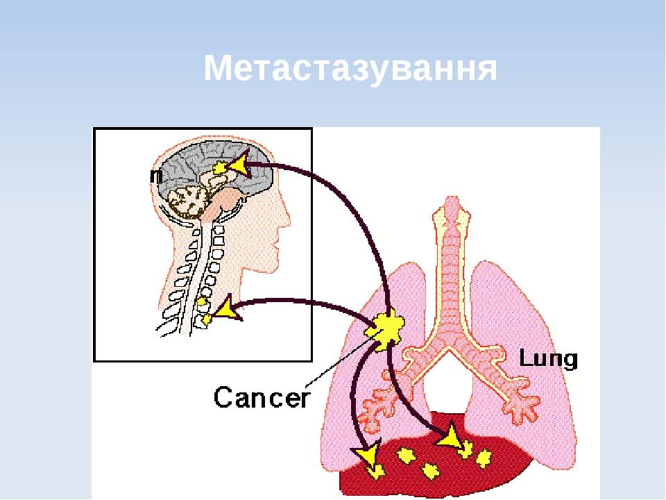 Метастазування