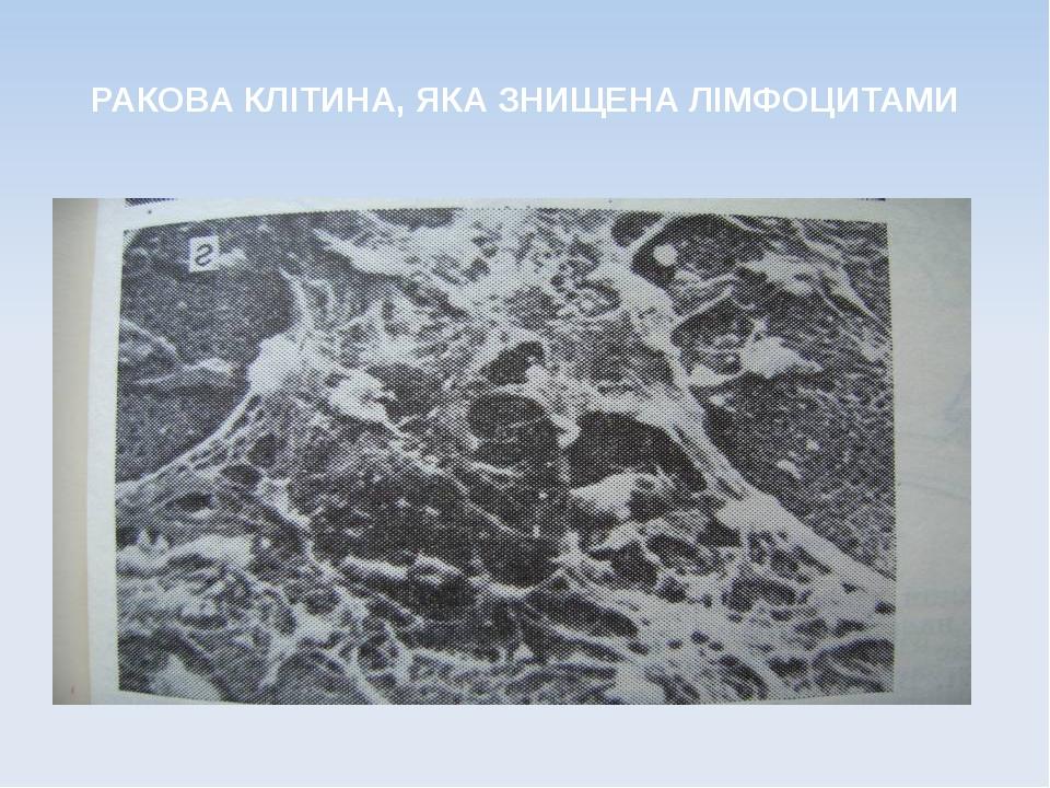 РАКОВА КЛІТИНА, ЯКА ЗНИЩЕНА ЛІМФОЦИТАМИ