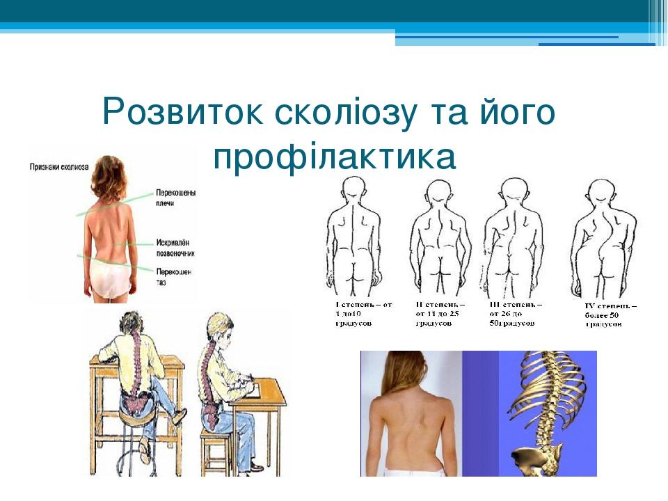 Розвиток сколіозу та його профілактика