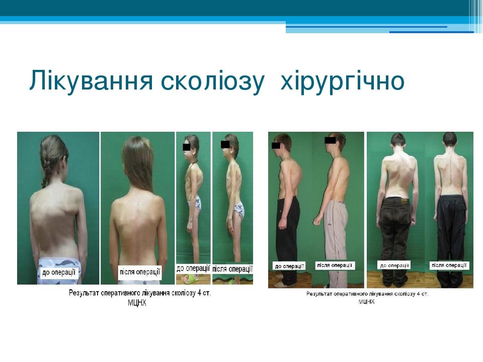 Лікування сколіозу хірургічно