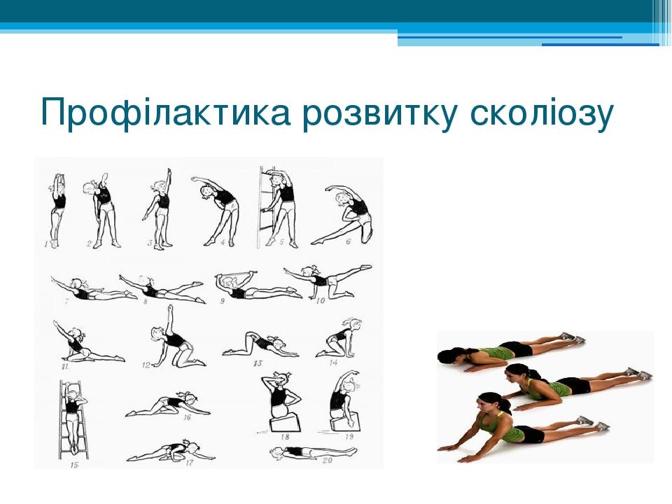 Профілактика розвитку сколіозу