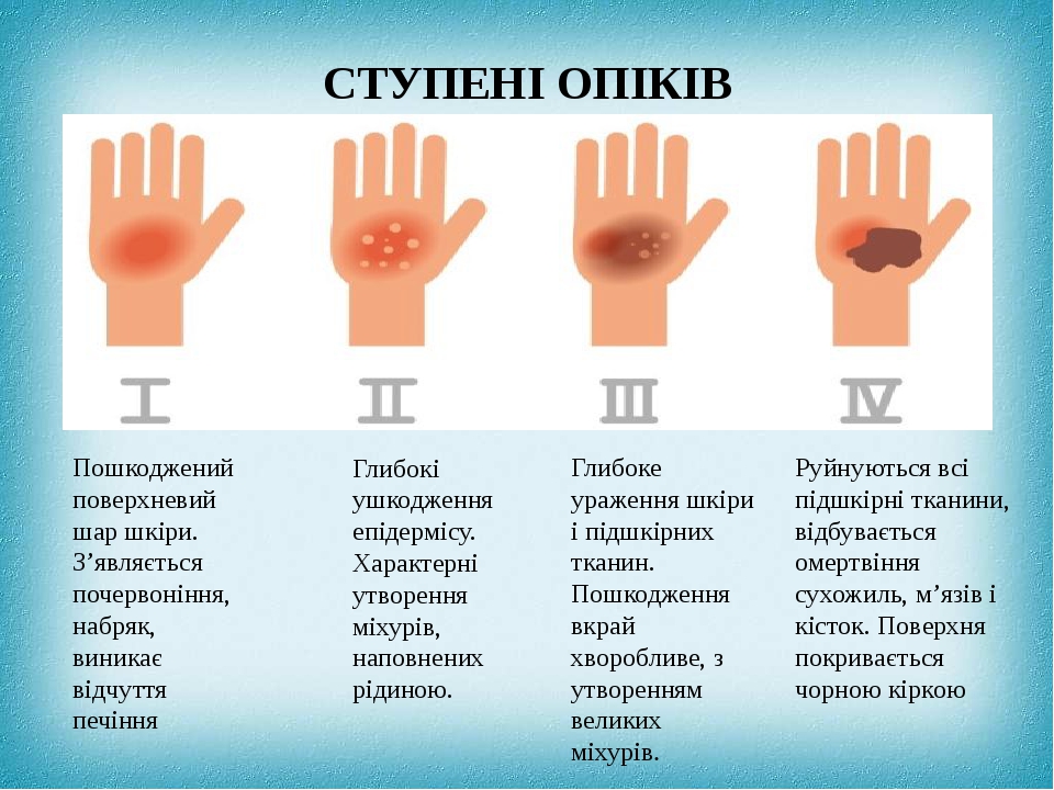 Презентація з ОБЖ "Небезпека опіків"