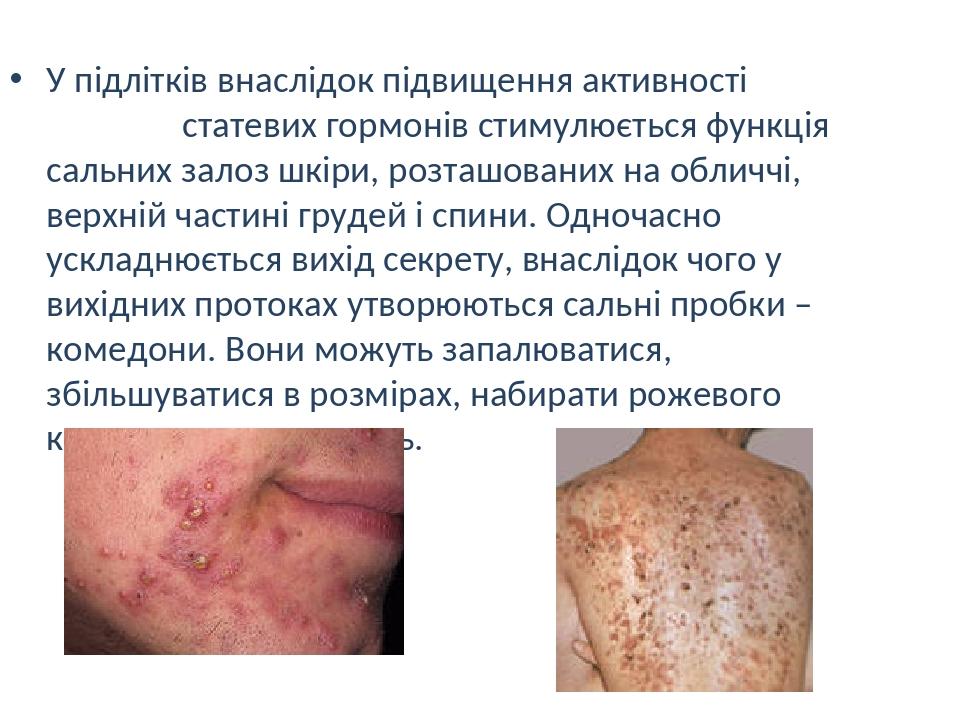 У підлітків внаслідок підвищення активності статевих гормонів стимулюється функція сальних залоз шкіри, розташованих на обличчі, верхній частині гр...