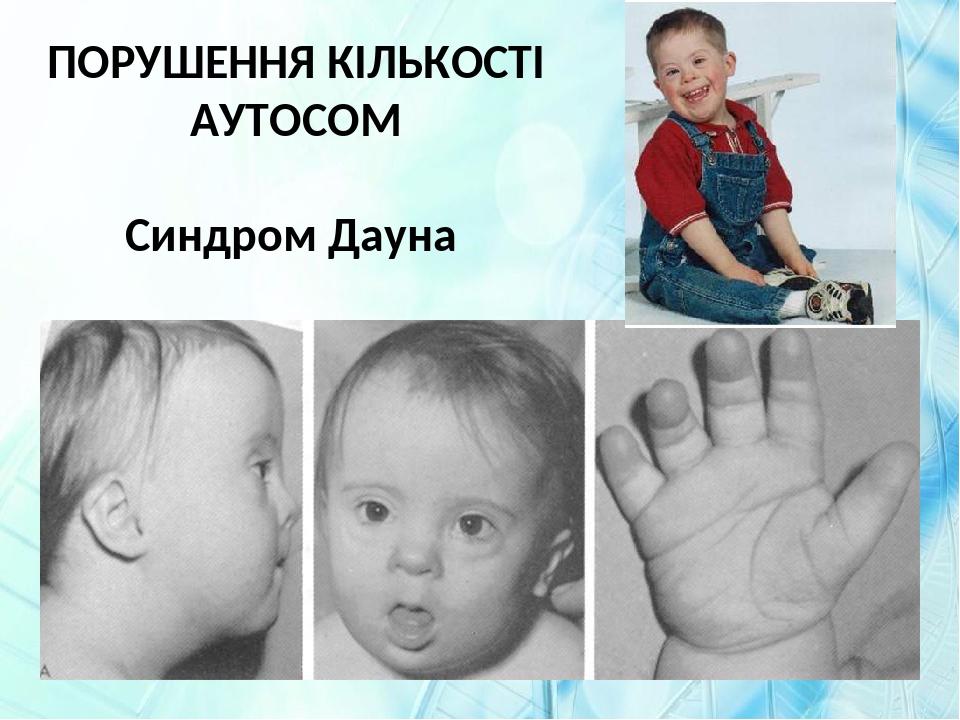 ПОРУШЕННЯ КІЛЬКОСТІ АУТОСОМ Синдром Дауна
