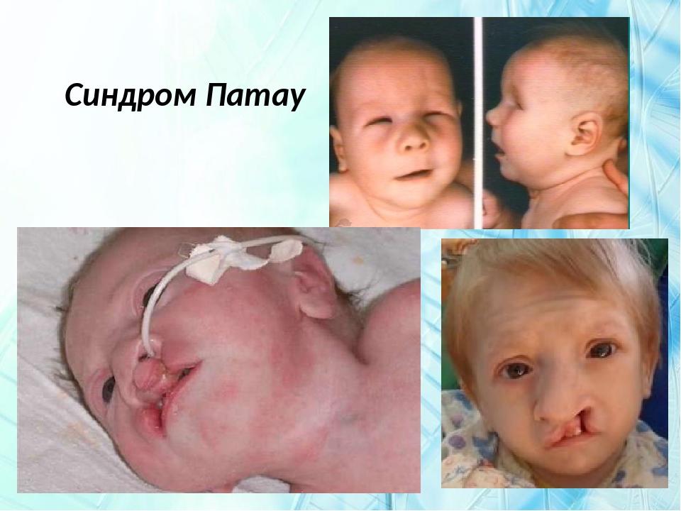 Синдром Патау