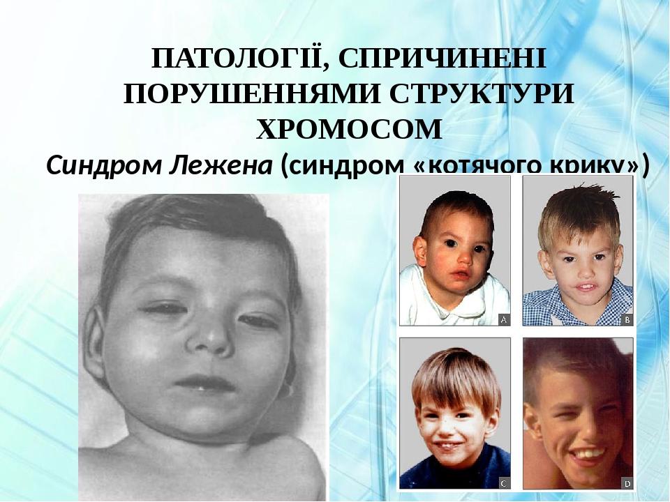 ПАТОЛОГІЇ, СПРИЧИНЕНІ ПОРУШЕННЯМИ СТРУКТУРИ ХРОМОСОМ Синдром Лежена (синдром «котячого крику»)