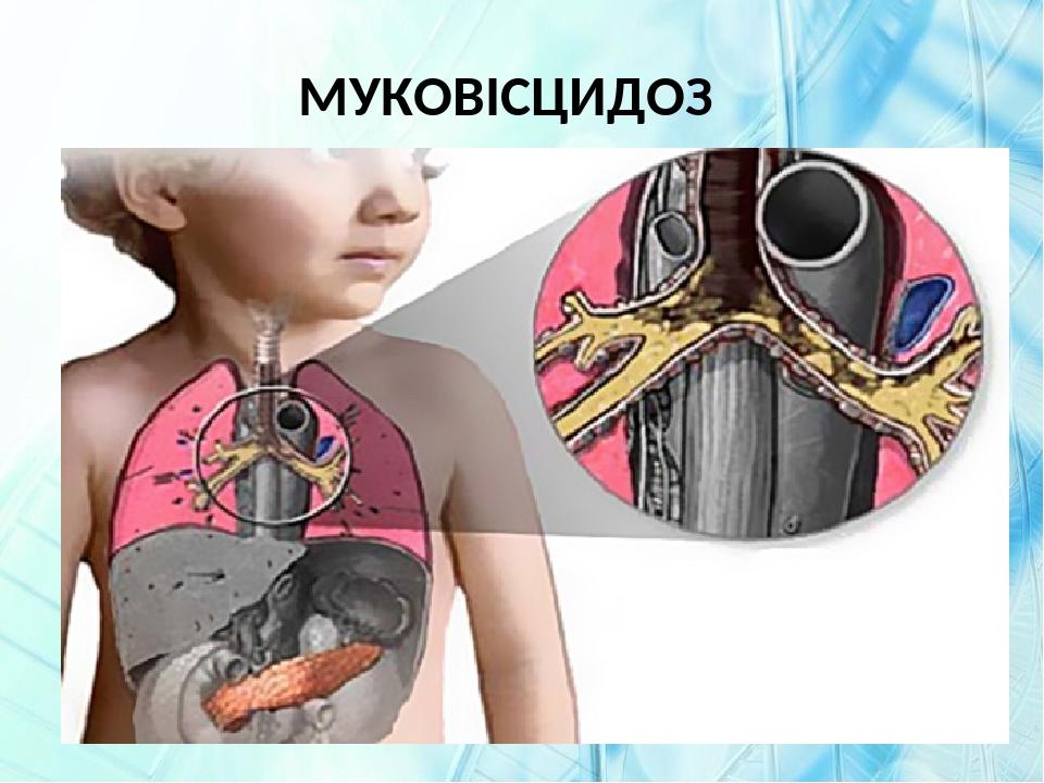 МУКОВІСЦИДОЗ