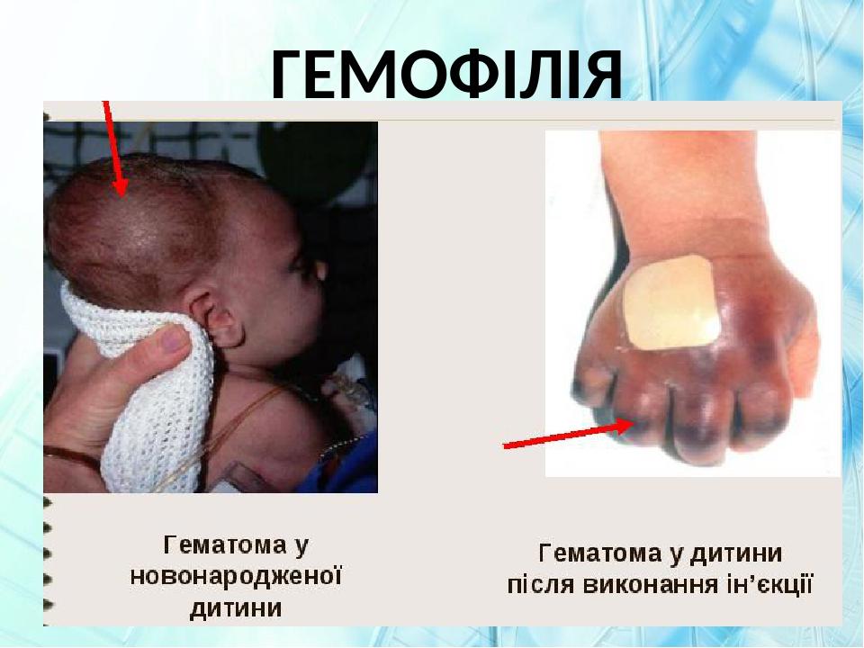 ГЕМОФІЛІЯ