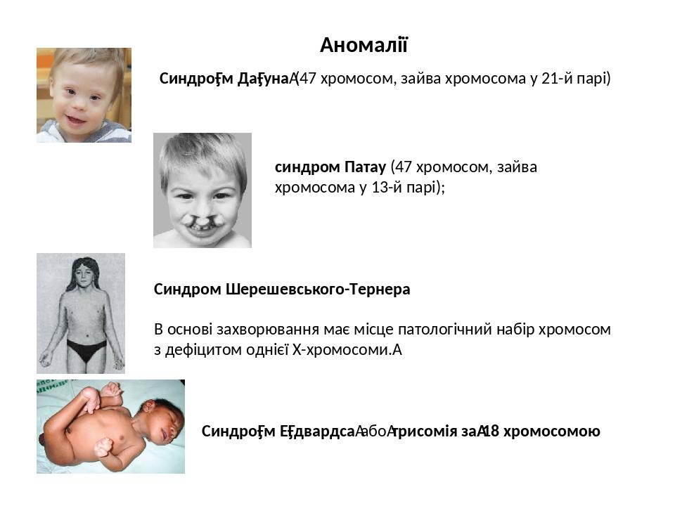 Аномалії Синдро́м Да́уна (47 хромосом, зайва хромосома у 21-й парі) Синдром Шерешевського-Тернера В основі захворювання має місце патологічний набі...