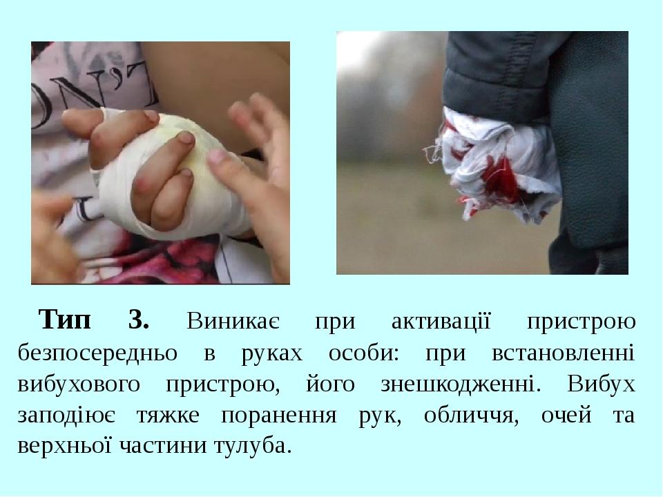Тип 3. Виникає при активації пристрою безпосередньо в руках особи: при встановленні вибухового пристрою, його знешкодженні. Вибух заподіює тяжке по...
