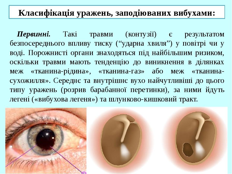 Класифікація уражень, заподіюваних вибухами: Первинні. Такі травми (контузії) є результатом безпосереднього впливу тиску (“ударна хвиля”) у повітрі...