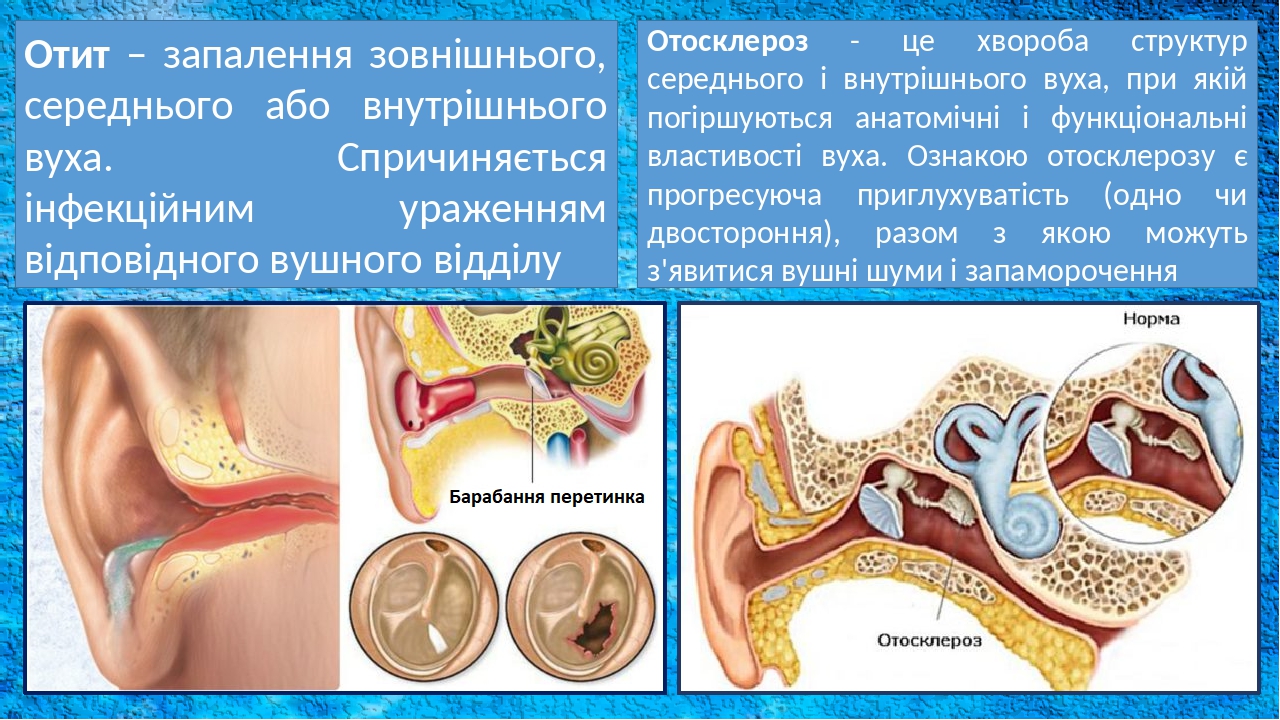 Отит – запалення зовнішнього, середнього або внутрішнього вуха. Спричиняється інфекційним ураженням відповідного вушного відділу Отосклероз - це хв...